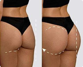 Anti-Sag Effect