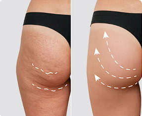 Bye Cellulite